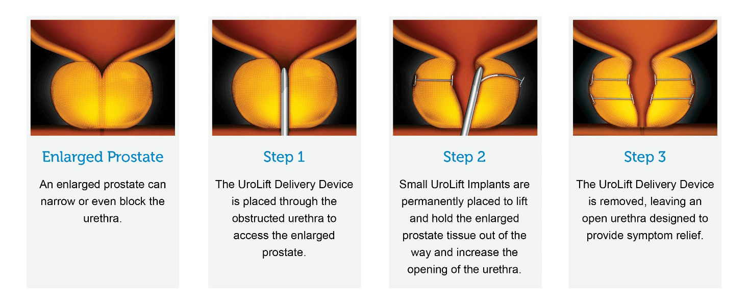 Urolift For Bph Miami Enlarged Prostate Treatment South Florida